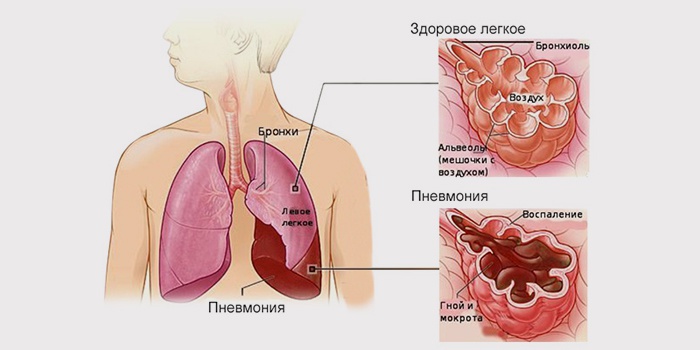 В неделю  профилактики заболеваний органов дыхания хотим напомнить про пневмонию