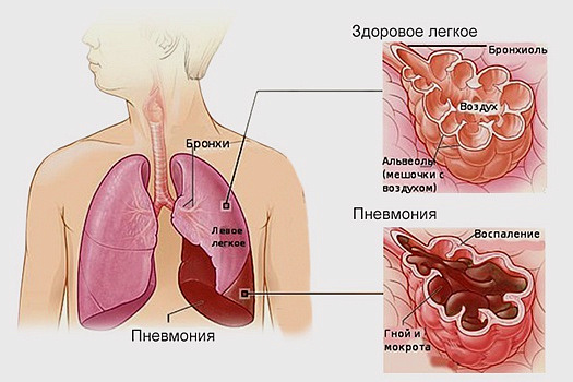 В неделю  профилактики заболеваний органов дыхания хотим напомнить про пневмонию