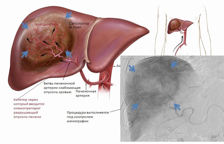 Эндоваскулярная химиоэмболизация печени при онкопатологии
