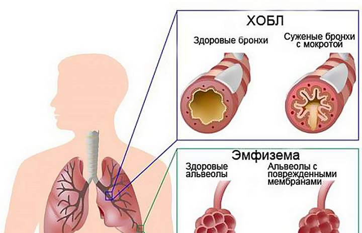 ХОБЛ-проблема 90% курильщиков!