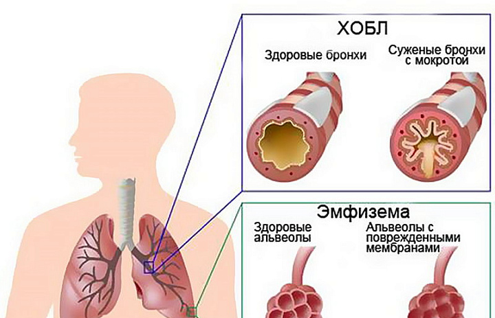 ХОБЛ-проблема 90% курильщиков!