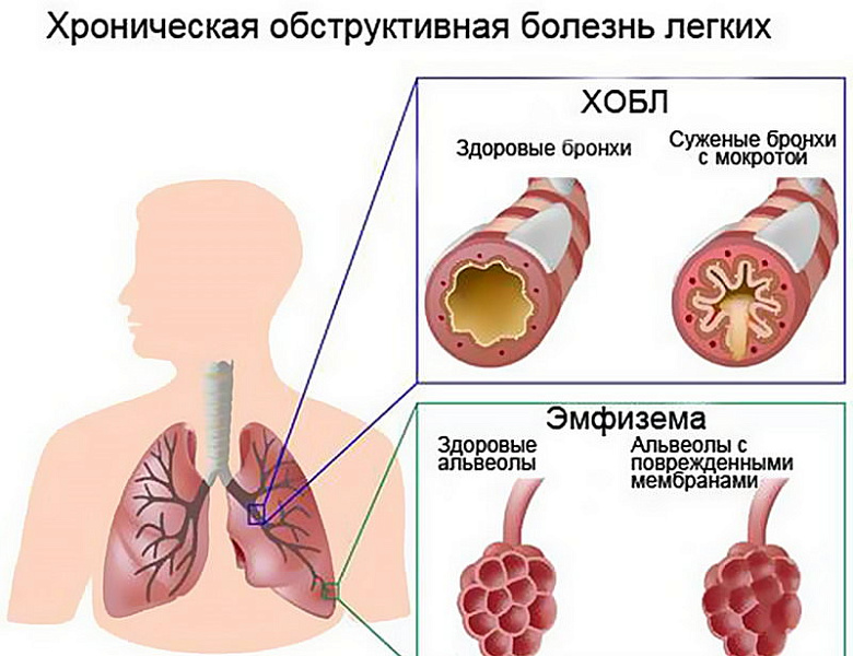 ХОБЛ-проблема 90% курильщиков!