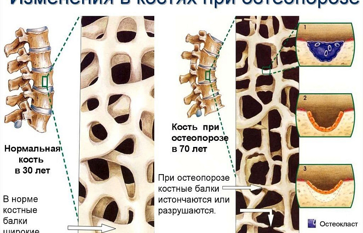 20 октября отмечается Всемирный день остеопороза