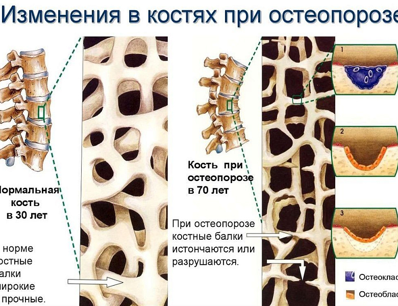 20 октября отмечается Всемирный день остеопороза