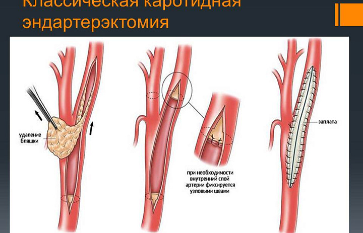 Междисциплинарная конференция по профилактике инсультов
