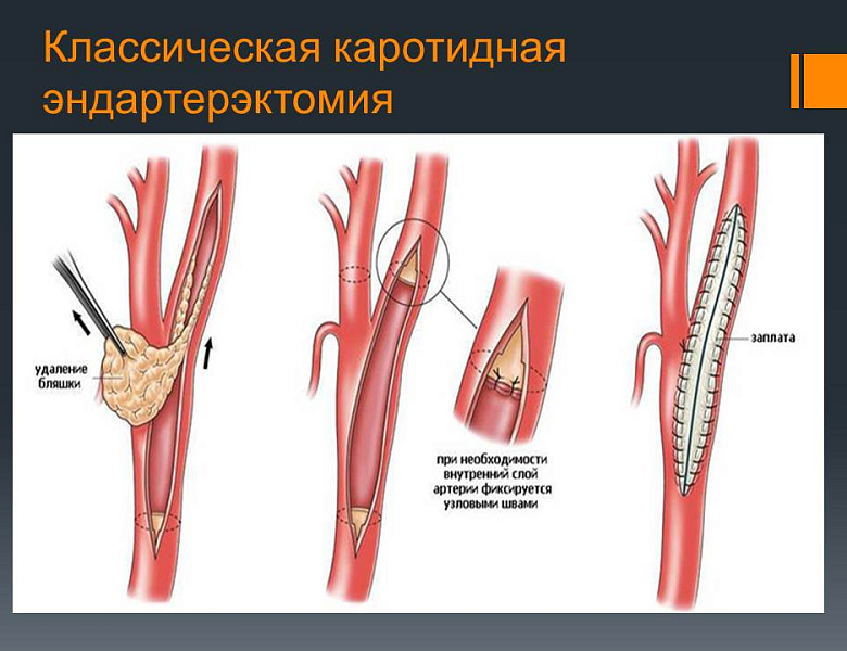 Междисциплинарная конференция по профилактике инсультов