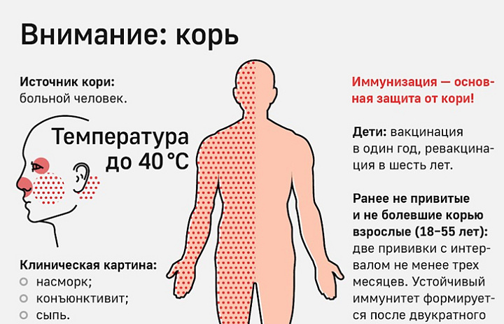 Непривитый от кори рискует на всю жизнь остаться с воспалением мозга